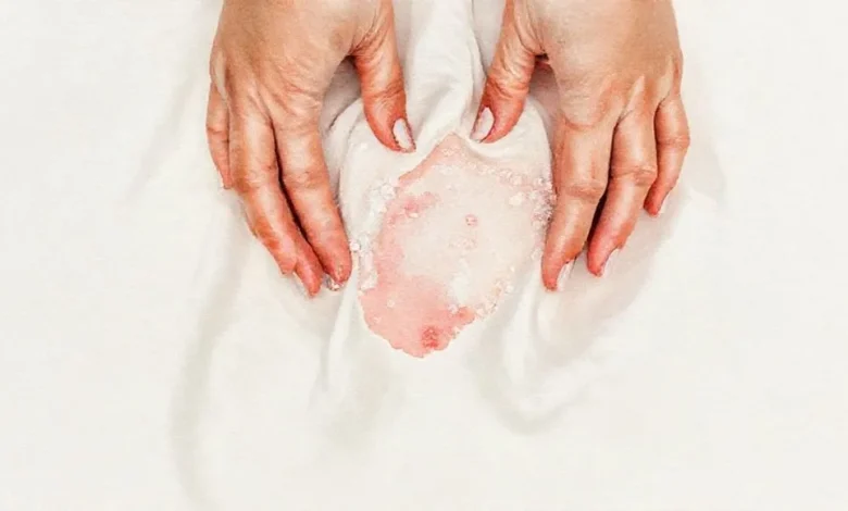 Kan Lekesini Çıkaran Soğuk Su ve Tuz Yöntemi